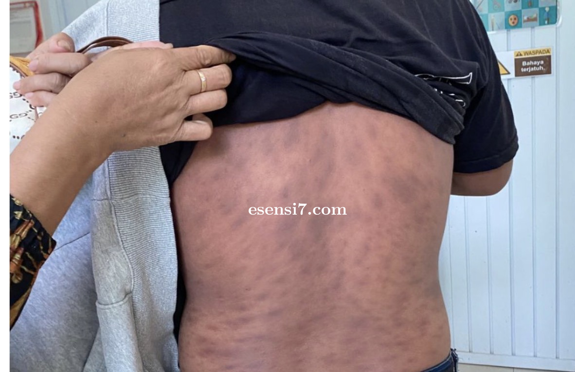 Prevalensi Kusta di Sulawesi Barat Masih Tinggi, Dinkes Perkuat Deteksi Dini dan Pengobatan